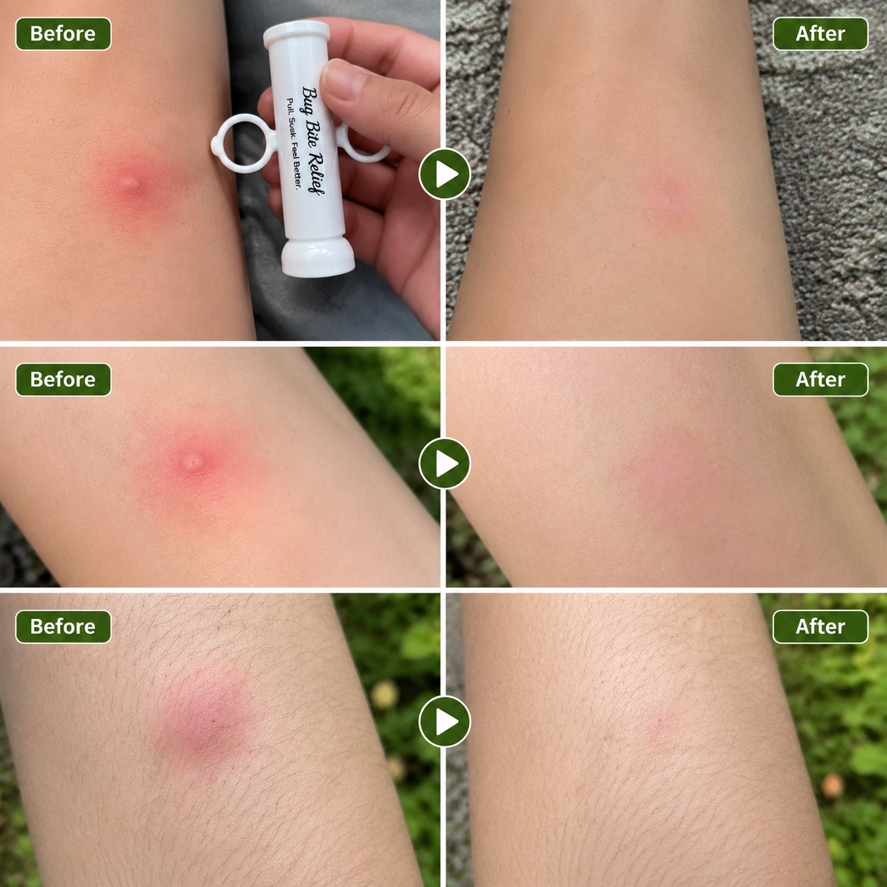 Bug Bite Thing Suction Tool,Poison Remover - Stop Mosquito Bite Itch In Seconds
